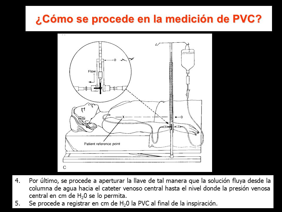 Medición de la presión venosa arterial